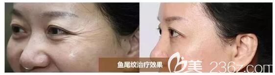 嗨体去除眼周皱纹案例分享