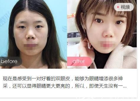 洛阳华美徐英杰医生双眼皮整形前后对比案例