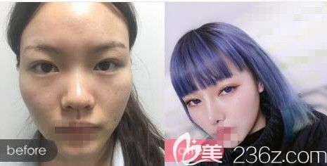 洛阳华美谢常礼医生隆鼻前后对比案例