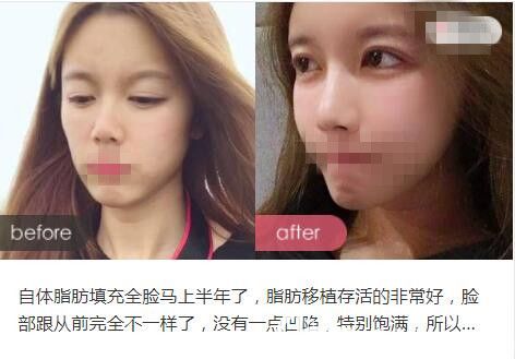 洛阳华美王旭明医生自体脂肪填充前后对比案例