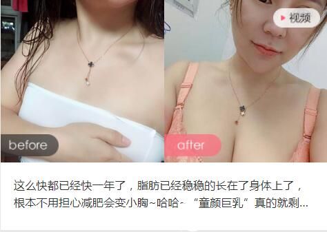 洛阳华美王旭明医生自体脂肪填充前后对比案例 洛阳华美王旭明医生隆胸前后对比案例