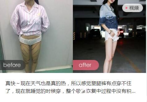 洛阳华美宋峻岭医生吸脂整形前后对比案例