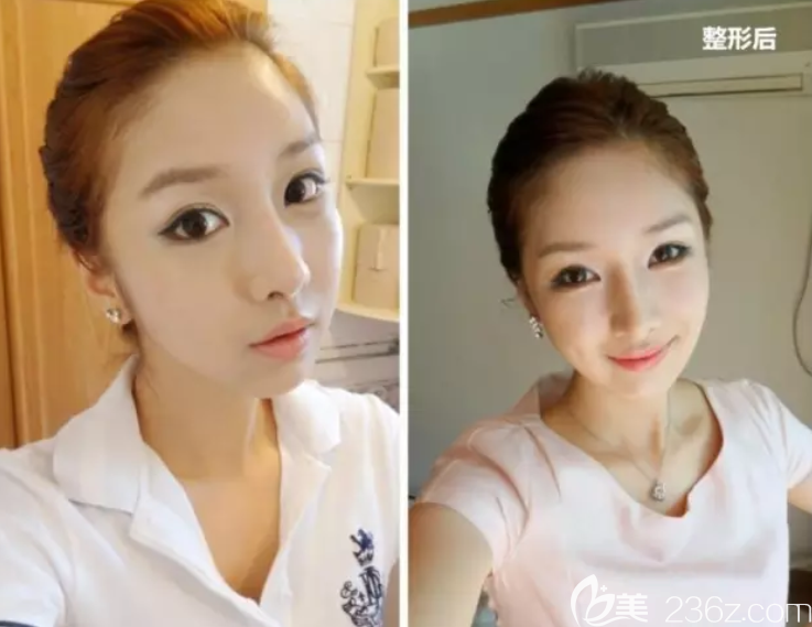 其实不丑却又在韩国高兰得做了隆鼻颧骨缩小下颌角缩小，我只是想美的更精致