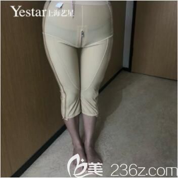 上海艺星医疗美容医院大腿吸脂真人案例术后第五天