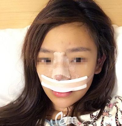在韩国博朗温做鼻综合手术后第2天