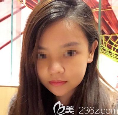 在韩国博朗温做鼻综合手术后第7天 在韩国博朗温做鼻综合手术后第7天