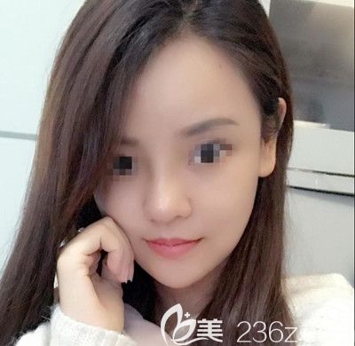 在韩国博朗温做鼻综合手术后第11天 在韩国博朗温做鼻综合手术后第11天