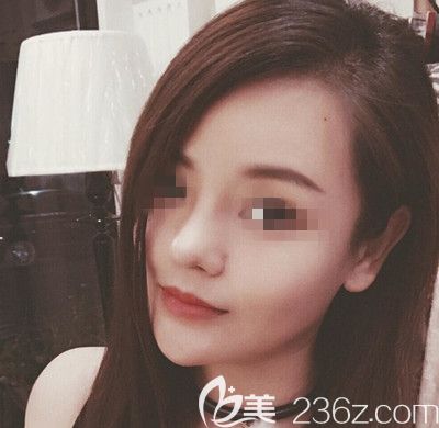 在韩国博朗温做鼻综合手术后第20天 在韩国博朗温做鼻综合手术后第20天