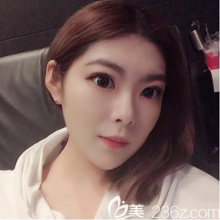 湛<!--<i data=20240703-sp></i>-->美双眼皮案例术后15天恢复效果 湛<!--<i data=20240703-sp></i>-->美双眼皮案例术后15天恢复效果