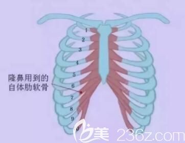 肋软骨隆鼻取肋软骨的位置 肋软骨隆鼻取肋软骨的位置