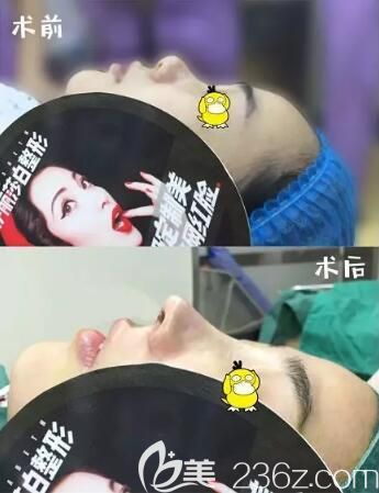 常德伊丽莎白整形医院肋软骨隆鼻真人案例前后对比效果 常德伊丽莎白整形医院肋软骨隆鼻真人案例前后对比效果