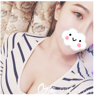 湛<!--<i data=20240703-sp></i>-->美丰胸案例1个月效果告诉你湛江隆胸哪家医院好 湛<!--<i data=20240703-sp></i>-->美丰胸案例1个月效果告诉你湛江隆胸哪家医院好