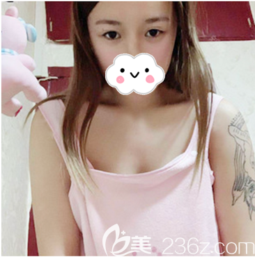 去湛<!--<i data=20240703-sp></i>-->美做隆胸手术前的样子 去湛<!--<i data=20240703-sp></i>-->美做隆胸手术前的样子