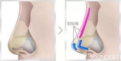 肋软骨隆鼻效果好吗?取肋软骨隆鼻对身体有害吗? 肋软骨隆鼻效果好吗?取肋软骨隆鼻对身体有害吗?