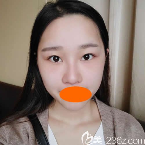 找赣州韩美何斌主任割7mm双眼皮术前照片 找赣州韩美何斌主任割7mm双眼皮术前照片