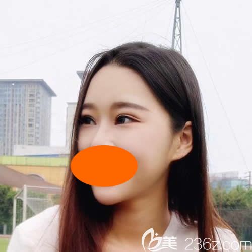 找赣州韩美何斌主任割7mm双眼皮术后第19天效果 找赣州韩美何斌主任割7mm双眼皮术后第19天效果