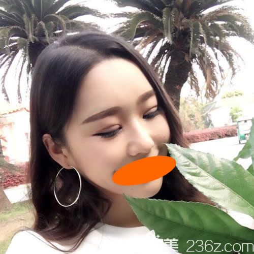 找赣州韩美何斌主任割7mm双眼皮术后第10天效果 找赣州韩美何斌主任割7mm双眼皮术后第10天效果