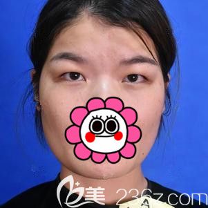 面诊徐州时光洪扬术前单眼皮 面诊徐州时光洪扬术前单眼皮