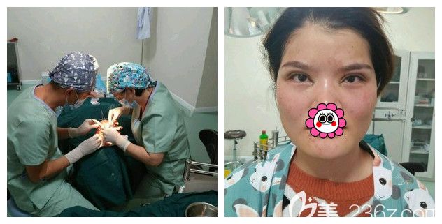 找徐州时光洪扬医生刚做完双眼皮+开眼角 找徐州时光洪扬医生刚做完双眼皮+开眼角