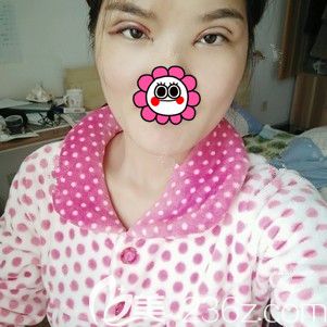 术后第二天双眼皮+开眼角恢复 术后第二天双眼皮+开眼角恢复