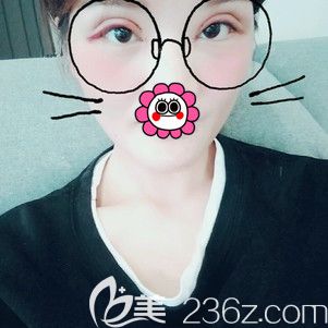 2天冰敷+1天热敷后双眼皮恢复效果 2天冰敷+1天热敷后双眼皮恢复效果