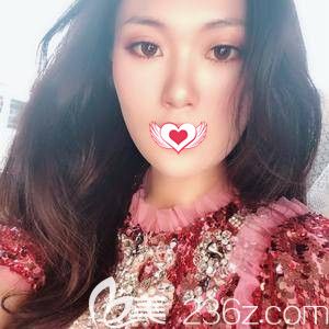 王亚勇为我这样双眼皮术后18天已经消肿 王亚勇为我这样双眼皮术后18天已经消肿