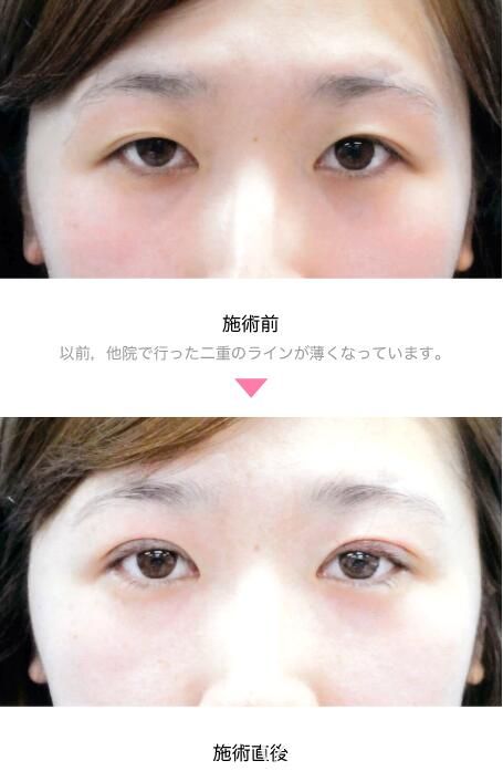 竹内重夫全切法双眼皮案例