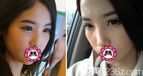 在韩国POP整形医院做鼻综合+全切双眼皮修复术前 在韩国POP整形医院做鼻综合+全切双眼皮修复术前