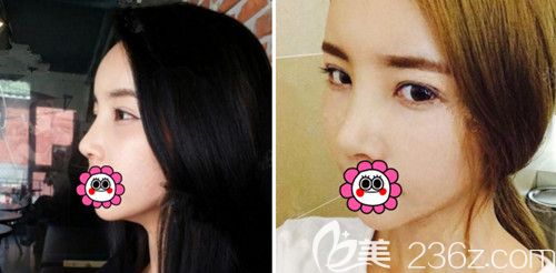 在韩国POP整形医院做鼻综合+全切双眼皮修复术后1个月 在韩国POP整形医院做鼻综合+全切双眼皮修复术后1个月