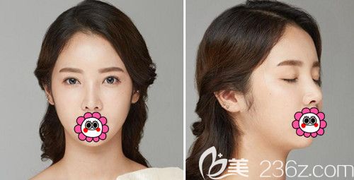 在韩国POP整形医院做鼻综合＋全切双眼皮修复+全脸脂肪填充半年效果