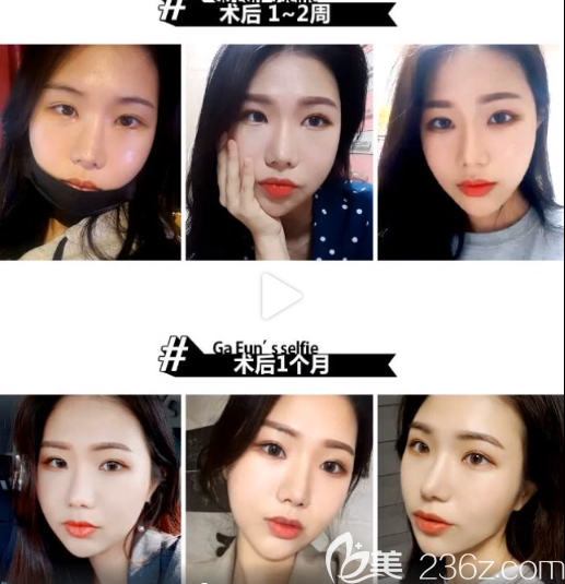 脸本脸骨整形外科facebone朴用南怎么样