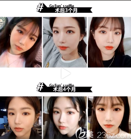 脸本脸骨整形外科朴用南颧骨案例