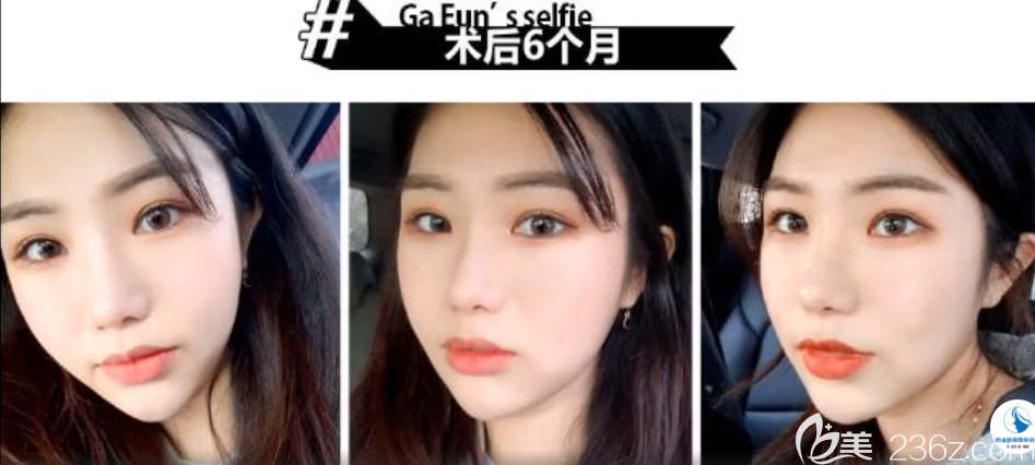 脸本脸骨整形外科facebone朴用南轮廓颧骨缩小邻家妹妹既视感