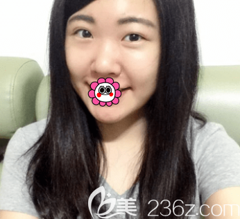 在北京新星靓做眼综合前样子 在北京新星靓做眼综合前样子