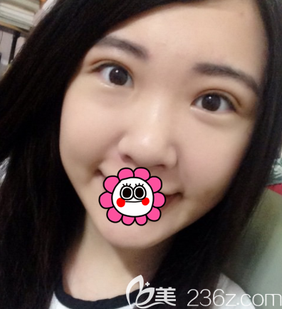 在北京新星靓做眼综合第21天 在北京新星靓做眼综合第21天