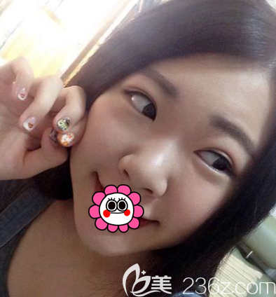 我在北京新星靓做完眼综合大概半个月左右就基本消肿了