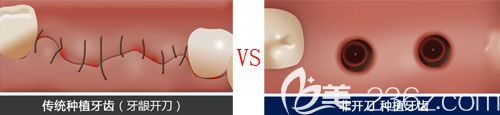 韩国来一菲不开刀种植牙与普通种植牙区别