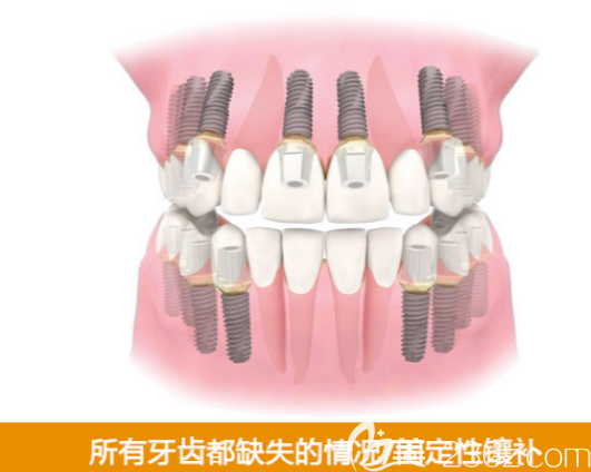 韩国来一菲LIVE牙科医院所有牙齿都缺失治疗办法