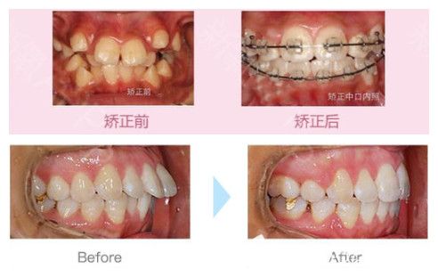重庆齐美牙齿畸形及成人深覆盖矫正案例效果