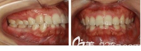 矫正前口腔内的牙齿情况