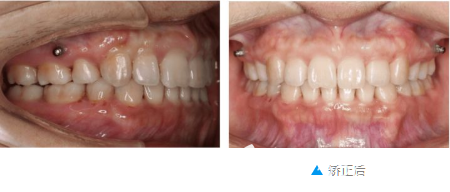 打支抗钉矫正的效果图