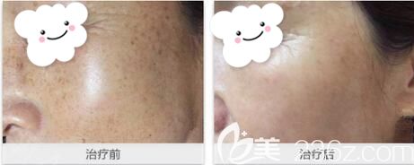 安琪儿整形皮秒激光美肤术前术后对比效果 安琪儿整形皮秒激光美肤术前术后对比效果