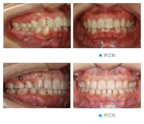 在重庆齐美口腔做完深覆合及龅牙矫正前后对比照