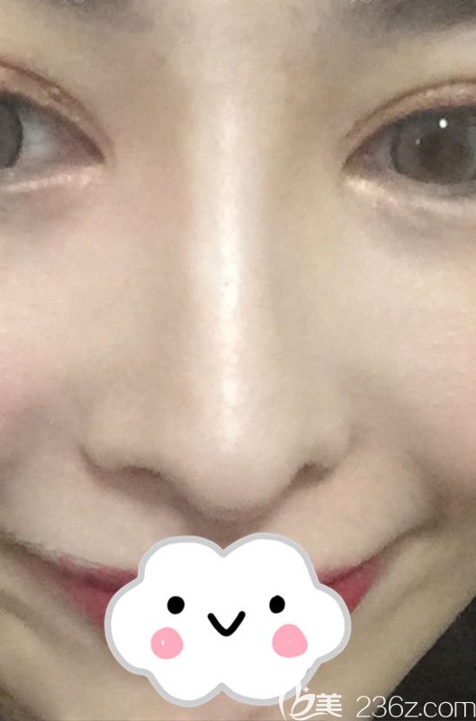 韩国娜娜整形外科医院金亨俊院长隆鼻失败修复真人案例 韩国娜娜整形外科医院金亨俊院长隆鼻失败修复真人案例