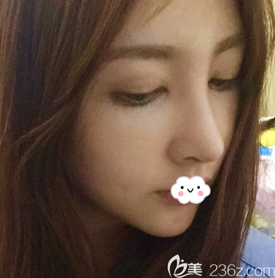 韩国娜娜整形医院隆鼻失败修复案例恢复过程图 韩国娜娜整形医院隆鼻失败修复案例恢复过程图