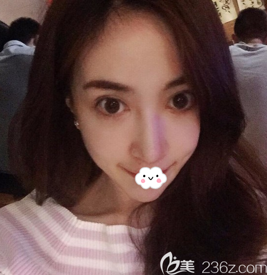 韩国nano整形医院金亨俊隆鼻失败修复案例术后3个月恢复照片 韩国nano整形医院金亨俊隆鼻失败修复案例术后3个月恢复照片