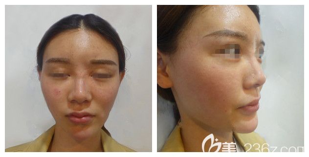 面诊徐州时光洪扬医生术前面颊凹陷 面诊徐州时光洪扬医生术前面颊凹陷