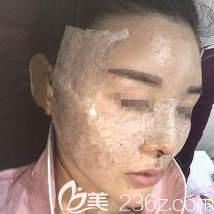 刚做完自体脂肪填充面部术后即刻 刚做完自体脂肪填充面部术后即刻