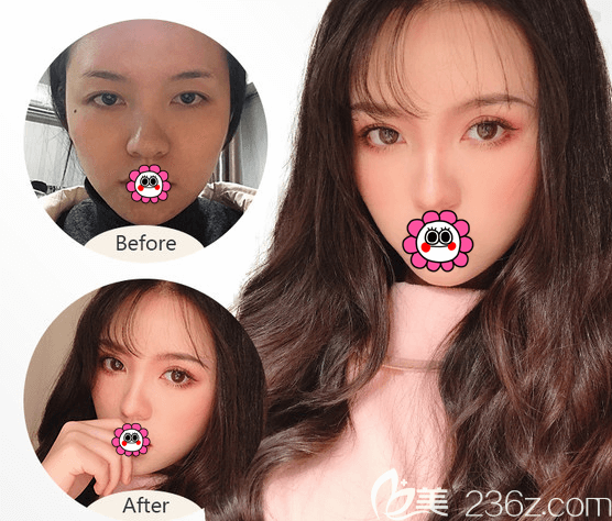 <!--<i data=20240703-sp></li>
<li><i data=20240703-sp></i>-->赵宏伟双眼皮修复案例