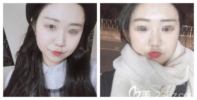 面诊常州美贝尔医生术前嘟嘟脸 面诊常州美贝尔医生术前嘟嘟脸